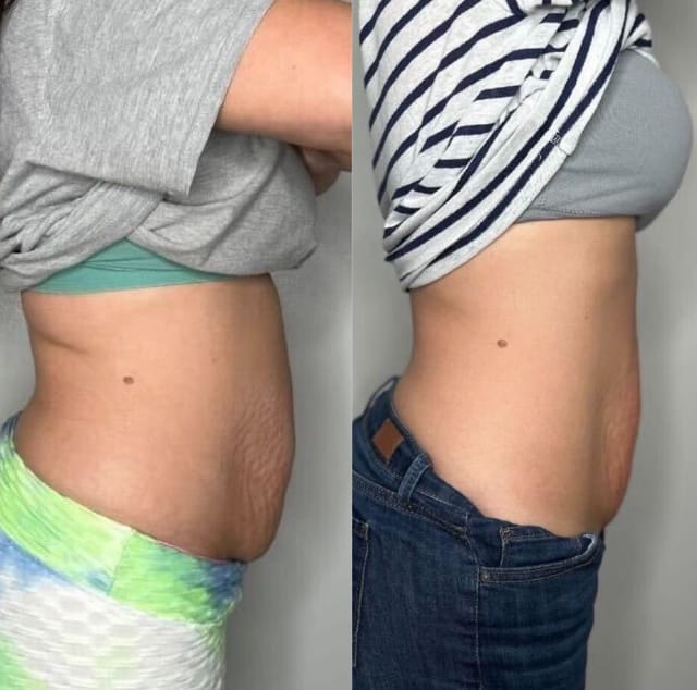 Cryo Slimming before and after results